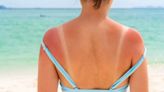Una dermatóloga explica qué debemos hacer si nos hemos quemado con el sol