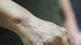 Leprosy could be endemic in Central Florida, researchers say. Here's what to know.