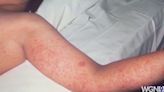 Are you protected against measles? Symptoms and treatment explained