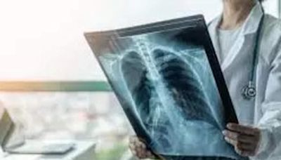 Burden of lung diseases in India likely much higher than Lancet study's projection: Doctors - ET HealthWorld