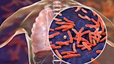 California sees 'substantial increase' in cases of tuberculosis