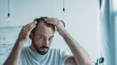 What Are the Side Effects of Topical Finasteride?