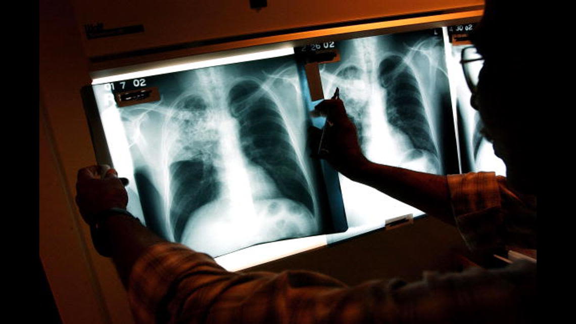 Long Beach detects localized tuberculosis outbreak