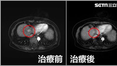 8旬嬤治癒C肝又續發肝癌 「拴塞＋放射治療」助清除癌細胞