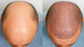How to know if (and when) you’re going to go bald