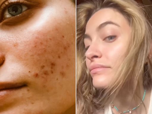 Paris Jackson Shares Unfiltered Photo of Her Acne and the Skincare Routine That Helped Her Breakouts