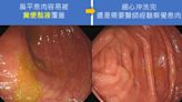 健檢正常3年後罹大腸癌！醫曝「扁皮息肉」元兇 揭4特性