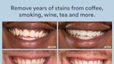 This Teeth Whitening Kit With 28K 5-Star Reviews Works ‘Instantly’