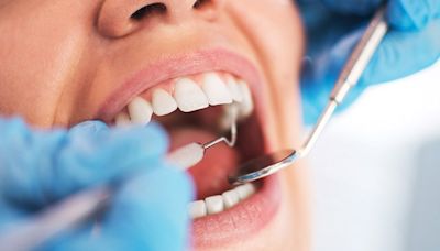 Antiplatelet Therapy and Bleeding After Dental Extraction
