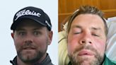 Westlife star Brian McFadden shares photo of unbelievable allergic reaction after bee stings his face