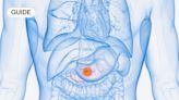 Pancreatic cancer: Symptoms, causes and treatment