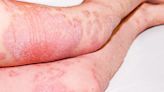 Refractory Psoriasis Can Be Overcome, Experts Say