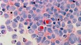 Study uncovers unknown interaction between leukemic cells and immune cells