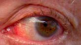 Glaucoma, la enfermedad silenciosa de los ojos provocada por la diabetes que “roba la visión”