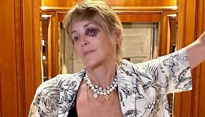 Sharon Stone reveals HOW she got that black eye