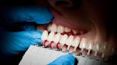 Before bleaching your teeth, have them professionally cleaned first