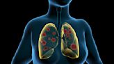 Enfermedades respiratorias agudas: cuáles son, síntomas, diagnóstico, tratamiento