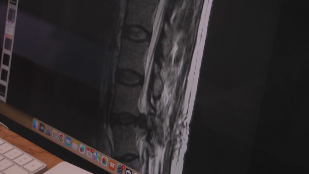HealthWatch: Relieving Back Pain: Fixing Failed Spine Surgeries