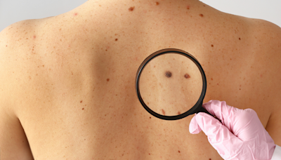 Here’s what to expect at your skin cancer screening exam