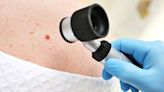 'Exciting' skin cancer vaccine halves risk of relapse or death in study
