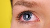 Here’s What Your Bloodshot Eyes Mean—and When They Could Indicate Something Serious