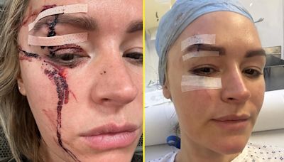 Laura Woods pulls out of Fury vs Usyk gig after shock injury in freak accident