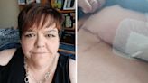 Woman was left in an eight day coma after a scratch by her bra caused a flesh-eating bug