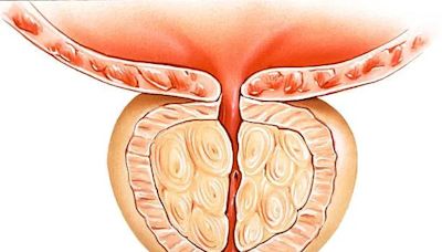 73歲老台商「攝護腺肥大」忍8年拖成癌！醫一看：腫瘤已穿透攝護腺