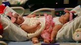 Conjoined Twins Fast Facts