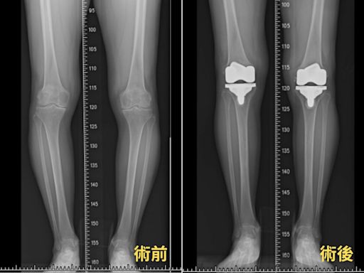 7旬婦退化性關節炎、O型腿 機器手臂關節置換術助恢復 - 自由健康網