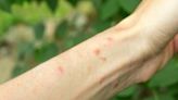 How to Tell the Difference Between Shingles & Poison Ivy