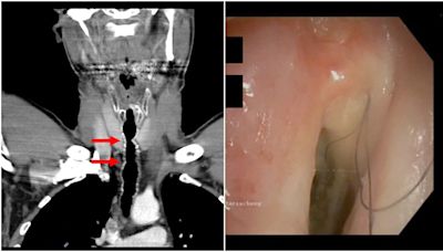 Austrian man grows hair inside throat after smoking for over 30 years; know all about the rare condition