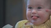 1-year-old Shakopee girl is first in country to receive heart device that fills a hole