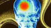 Climate Change Now Linked To Rise In Strokes