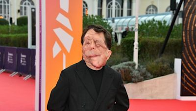 Qu’est-ce que la neurofibromatose, la maladie dont souffre l’acteur Adam Pearson ?