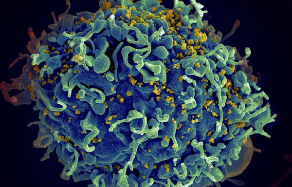 A 7th person with HIV is probably cured after stem cell transplant for leukemia, scientists say