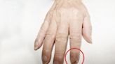 食指指甲又腫又痛數個月 男子竟是皮膚癌長在指甲上！