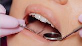 牙結石多久清一次？ 醫師曝「兩大關鍵」決定洗牙週期