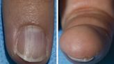 NIH Reports Benign Nail Condition Linked to Rare Syndrome that Greatly Increases Cancer Risk