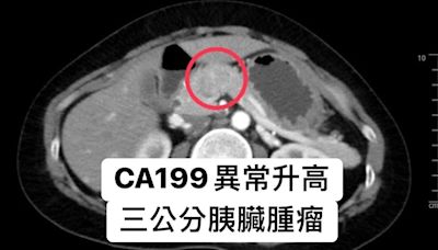 40歲女不煙不酒 檢查恐患胰臟癌 7成早期無症狀這些族群高危