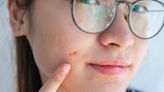 Acne Is Still Seen As Unprofessional In The Workplace. That Needs To Change.