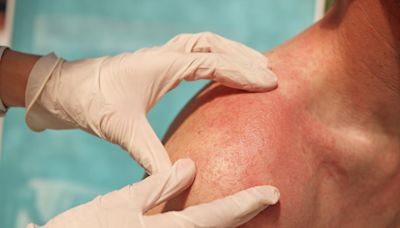 What does a heat rash look like? How to identify and treat it