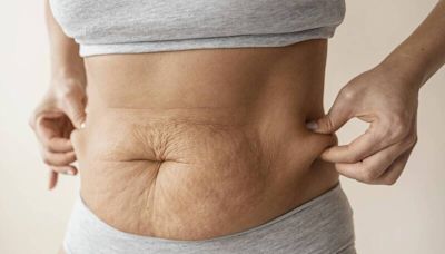 健康網》白色皺紋＝肥胖痕跡？ 常見5類人：女發生率是男2倍 - 自由健康網