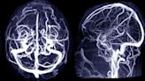 What Is a Cerebral Aneurysm? What Are the Signs?