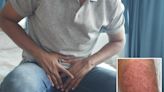 New, contagious fungal infection found in NYC after patient reported groin lesions – here’s how to keep yourself safe