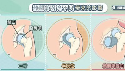 包巾別裹太緊，小心寶寶「髖關節發育不良」！醫：嚴重恐關節脫臼