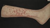 Erythema marginatum