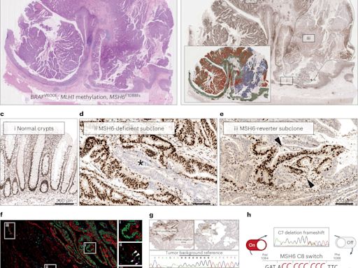 Bowel cancer turns genetic switches on and off to outwit the immune system, new study finds