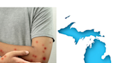 Michigan reports 3 measles cases as outbreak continues in Florida, other states