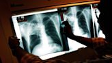 Tuberculosis cases continued climbing in 2023